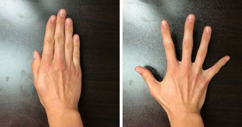 Hand Therapy Exercises Fingers