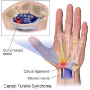 Carpal Tunnel Syndrome