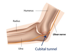 cubital tunnel ulnar nerve