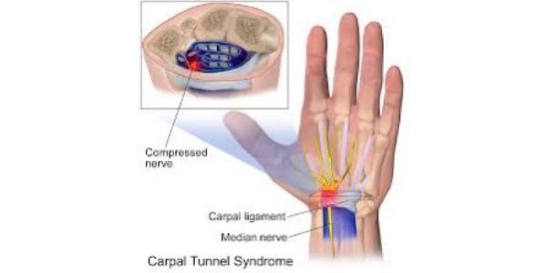 Carpal Tunnel Syndrom Facts - Trio Rehabilitation & Wellness Solutions