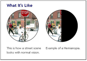 Hemianopsia Vision